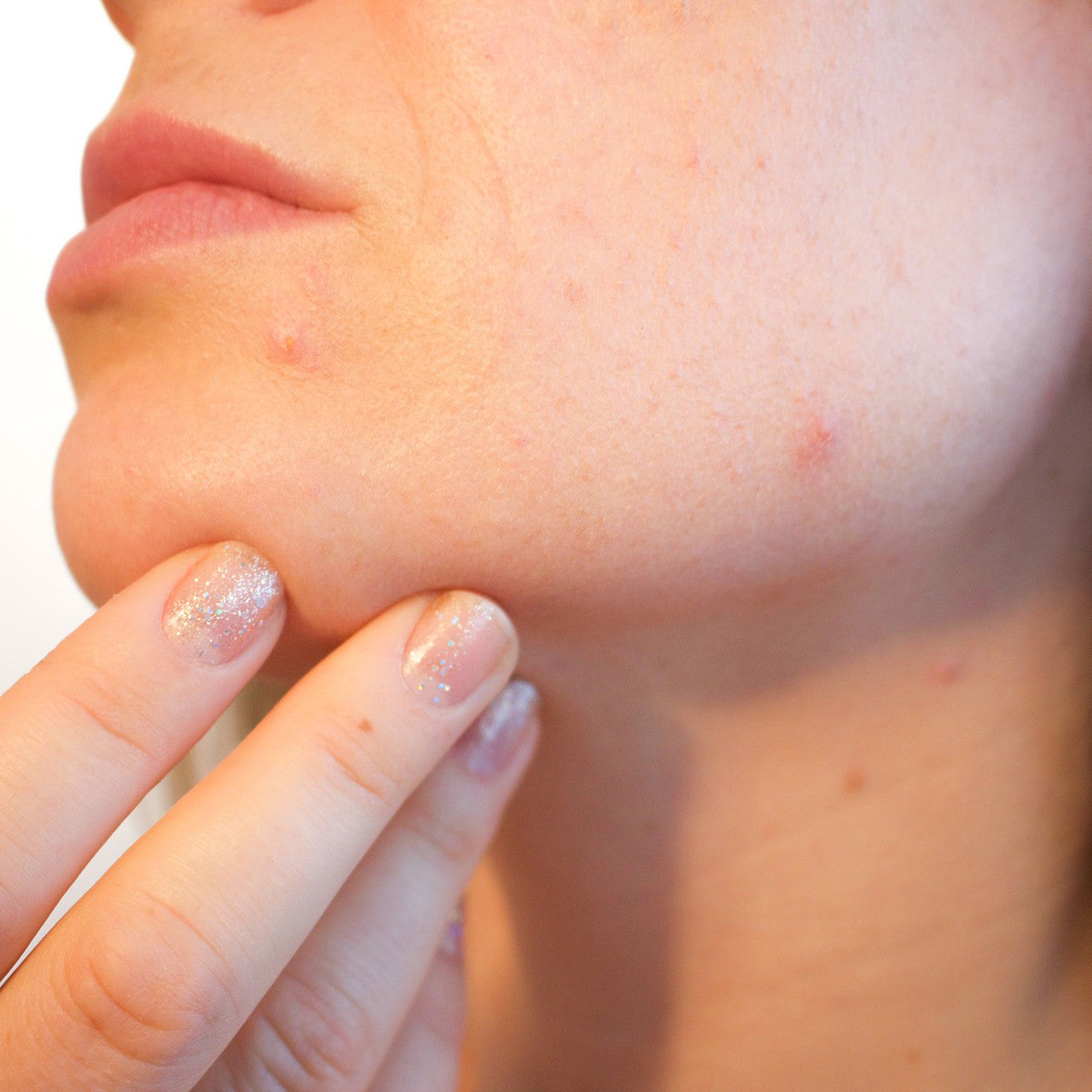 The BEST Anti-Blemish Spot Treatment - only 2 ingredients!